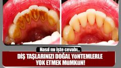 Diş taşlarınızı doğal yöntemlerle yok etmek artık mümkün…