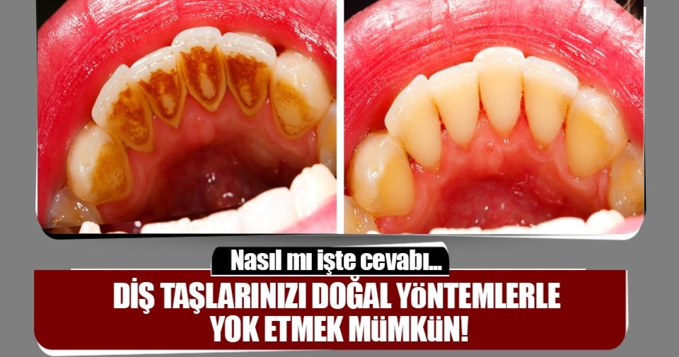 Diş taşlarınızı doğal yöntemlerle yok etmek artık mümkün…