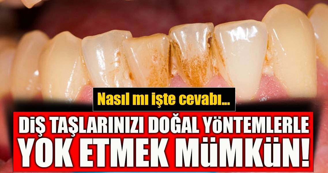 Diş taşlarınızı doğal yöntemlerle yok etmek artık mümkün…