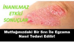 Mutfağınızdaki Bir Sıvı İle Egzama Nasıl Tedavi Edilir