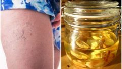 Örümcek Damarları Azaltmak İçin Doğal Yöntem