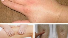 Vücutta Sıvı Tutulmasını Bu Yöntemle Çözeceksiniz