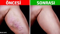 Varisli Damarlardan Kurtulmak İçin Evde Uygulanabilecek 8 Yöntem