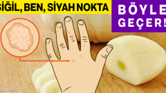 Siğil, Ben, Siyah Nokta ve Yaşlılık Lekeleri Nasıl Ortadan Kaldırılır?